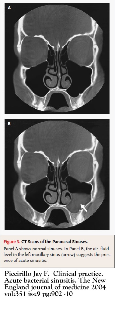 File:CT scan paranasal sinuses 1.jpg