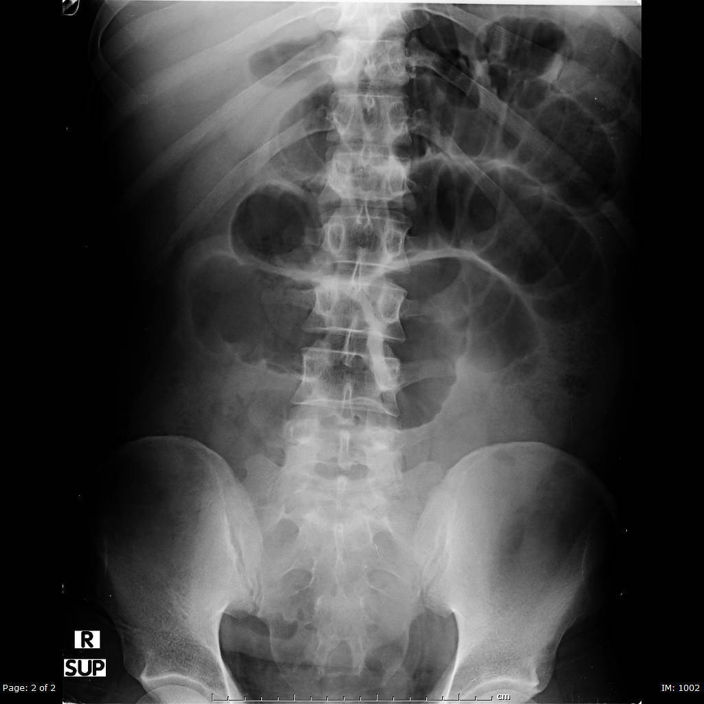 File:Diverticulitis abdominal x ray.jpeg
