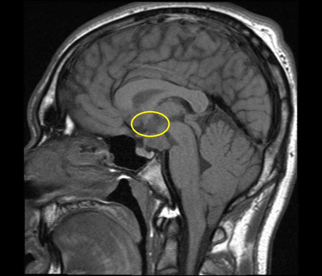 Hypothalamic lesion - Case courtesy of A.Prof Frank Gaillard, Via Radiopaedia.org[9]