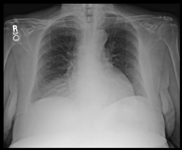 Mass adjacent to heart seen on routine pre-employment chest x-ray