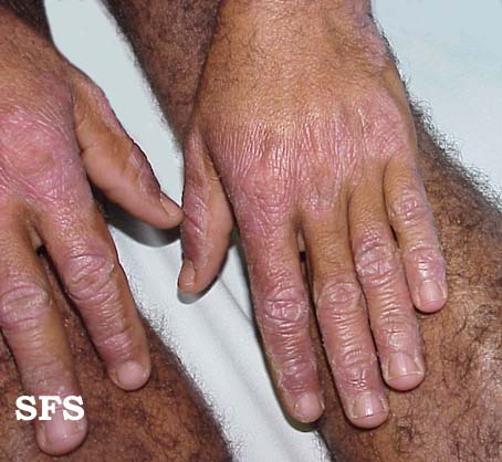 Pellagra. With permission from Dermatology Atlas.[7]