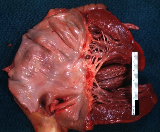 Rheumatic mitral valvulitis: gross, an example of fibrosis, chorda thickening and shortening with thrombus around the large left atrium.