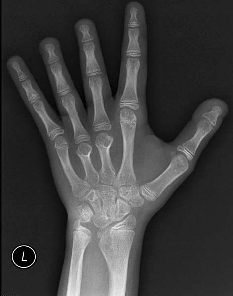 File:Turners-syndrome-hand-001.jpg