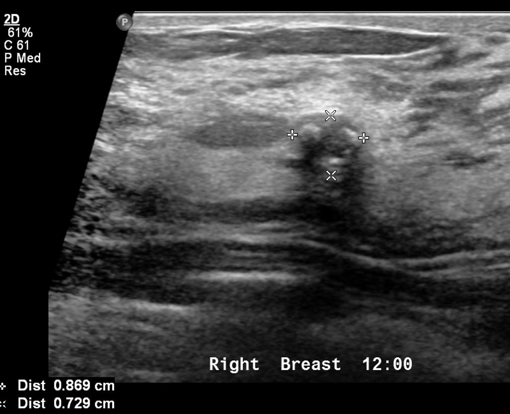 File:Ultrasound fibro 3.jpg