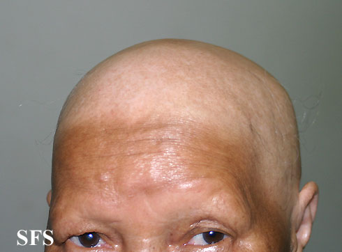 File:Alopecia areata 28.jpeg