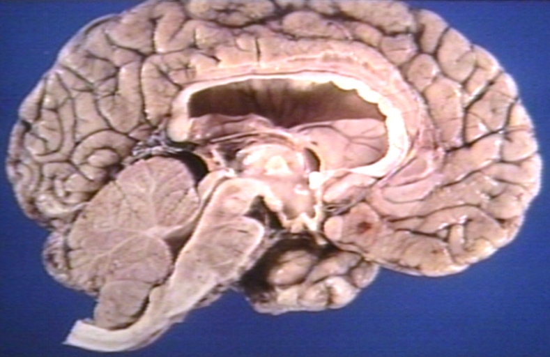 Brain: Arnold Chiari Malformation; with Hydrocephalus, Type I