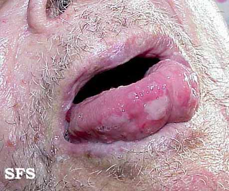 Bullous pemphigoid. With permission from Dermatology Atlas.[1]