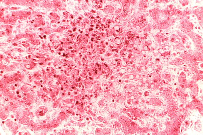 Cytoarchitectural changes found in a liver tissue specimen extracted from a Congo/Crimean hemorrhagic fever patient (280X mag). From Public Health Image Library (PHIL). [5]