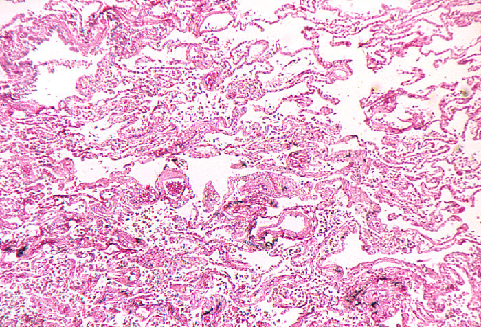 "Photomicrograph of lung tissue demonstrating pneumonia in a case of fatal human inhalation anthraxAdapted from Public Health Image Library (PHIL), Centers for Disease Control and Prevention.[21]