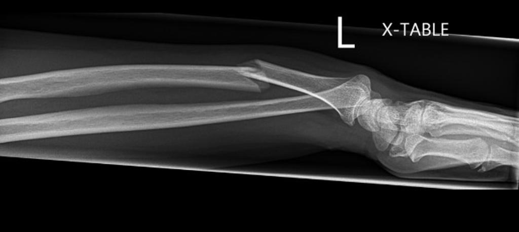 Lateral- Type 1 Galeazzi fracture