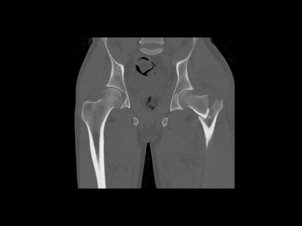 Coronal non-contrast. Comminuted intertrochanteric fracture involving the left proximal femur with internal rotation the femur following a road traffic accident.
