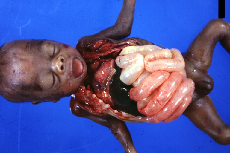 Intestine: Ileus Newborn Cause Unknown: Gross natural color opened body with protruding grossly dilated loops of bowel there was no evidence of necrotizing enteritis