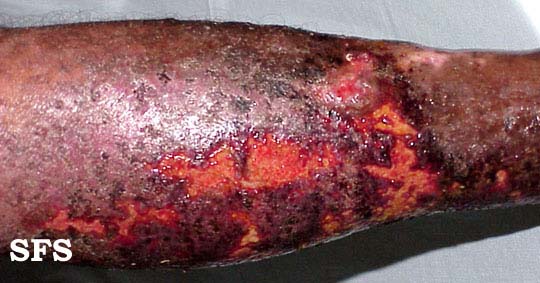 File:Eczema microbic03.jpg