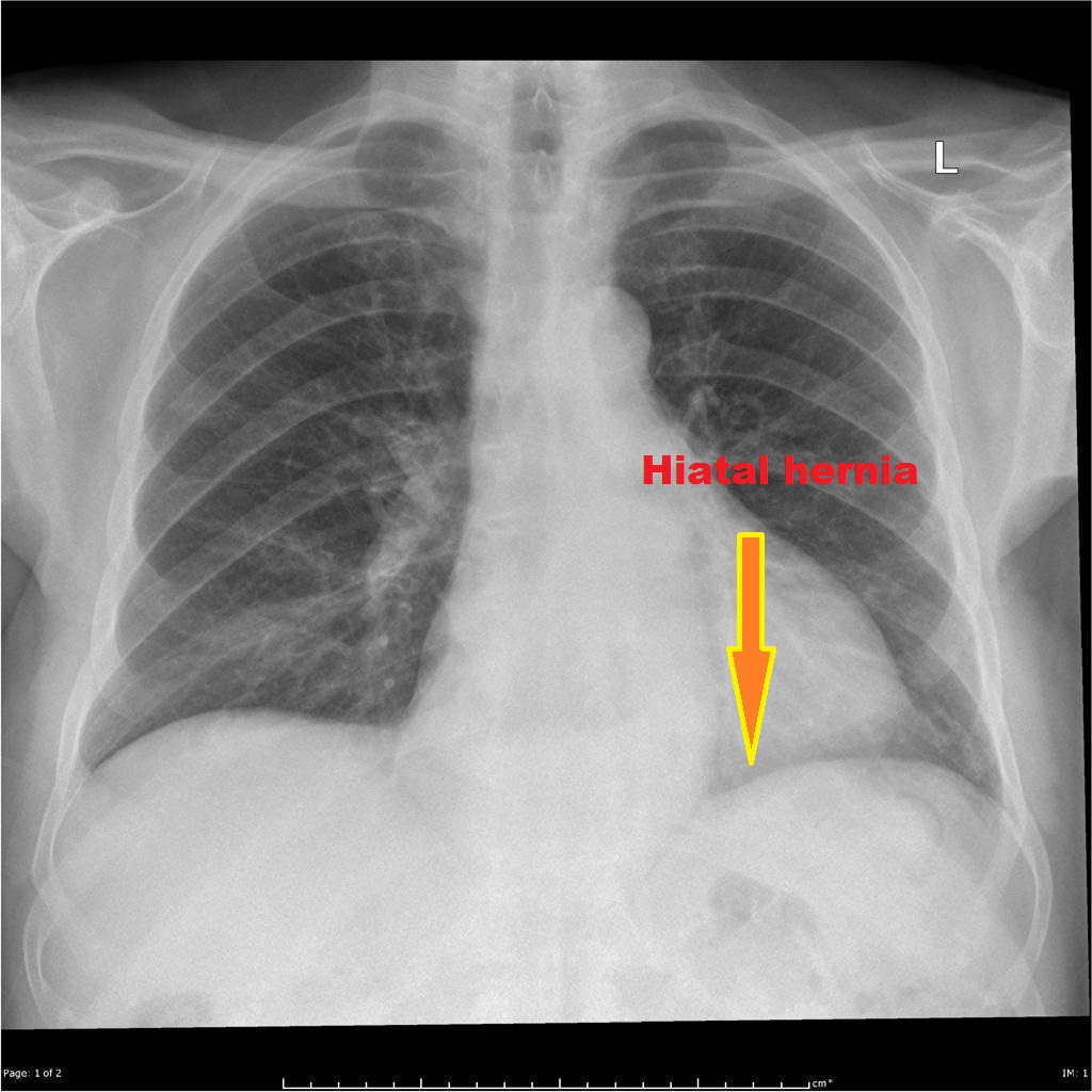 Ches X-ray: A Hiatal hernia- Frontal view Air-fluid level behind the heart on the lateral radiograph.