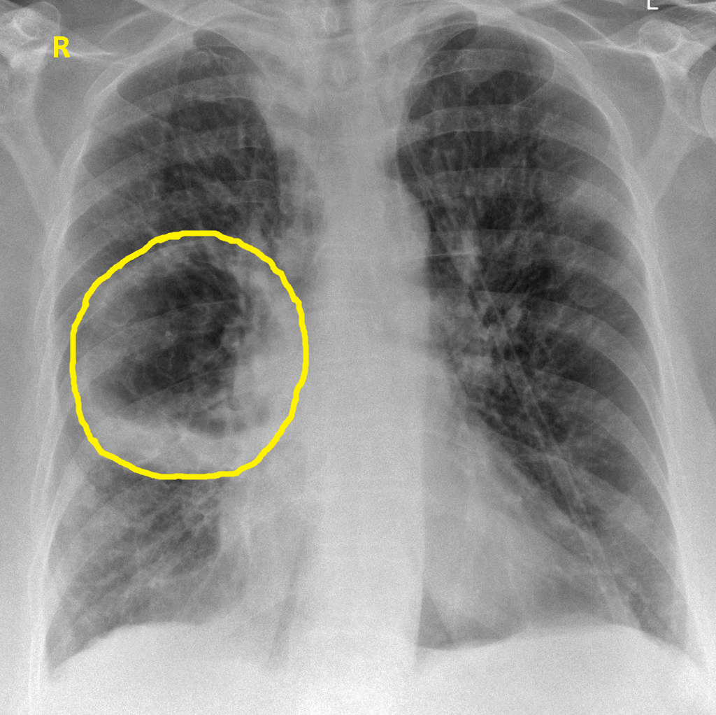 File:Lung abscess X-ray1 .gif.gif