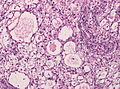 A smear showing microcystic meningioma with cystic appearance and increased pleomorphism of the elongated cells