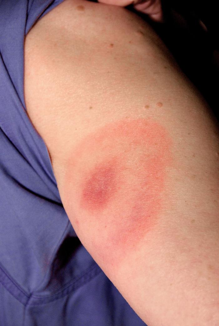 Pathognomonic erythematous rash in the pattern of a “bull’s-eye”. Patient subsequently contracted Lyme disease. - Source: Public Health Image Library (PHIL).