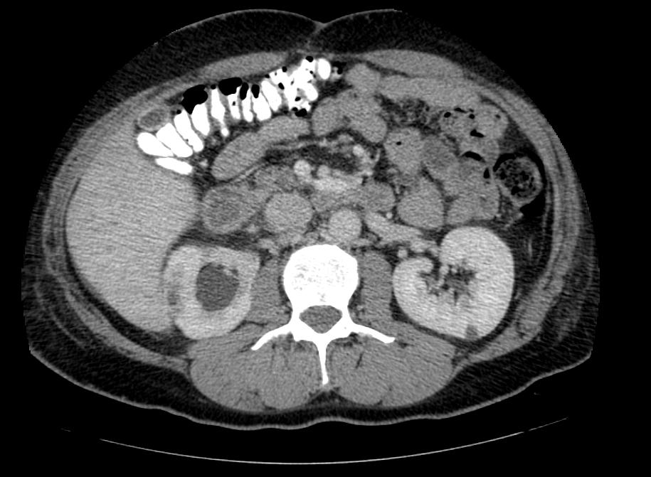 CT image demonstrates chronic pyelonephritis on the right