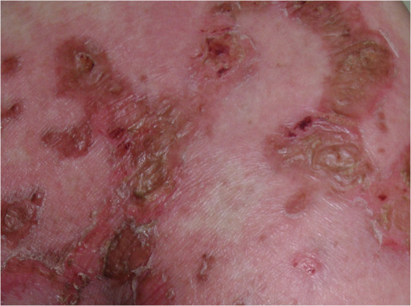Close-up view of well demarcated erythematous plaques, with fragile vesicles on gluteal area[8]