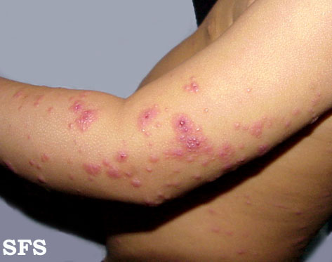 Eczema Herpeticum Wikidoc
