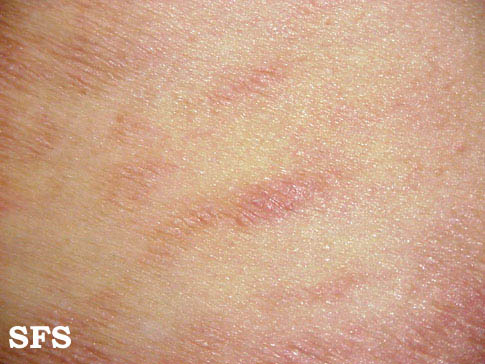 Large plaque parapsoriasis. With permission from Dermatology Atlas.[4]