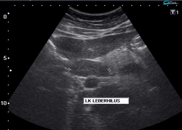 Oblique view: Splenic diameter about 20 cm in the long axis. Subhepatic enlarged lymph nodes.[2]