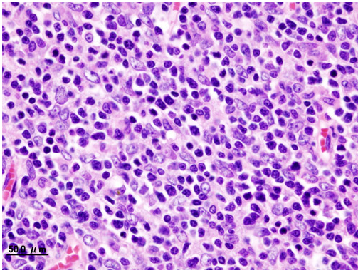 Histopathological image of Thymoma type B1. Anterior mediastinal mass surgically resected. Hematoxylin & eosin stain