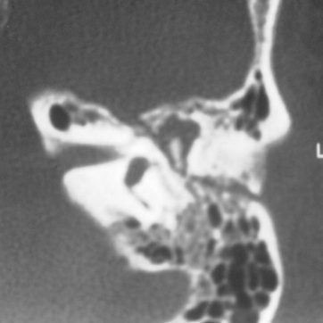 Axial CT scan showing oblique left temporal bone fracture [1].