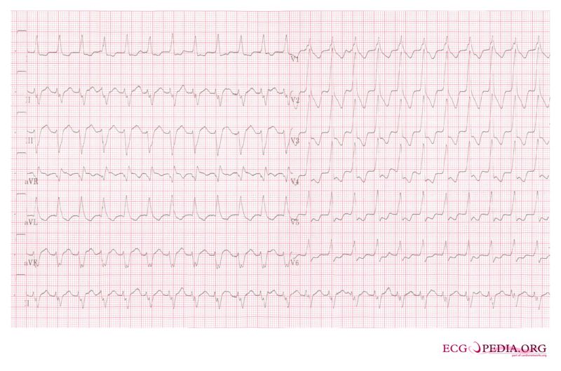 File:Ventricular Tachycardia 1.jpg
