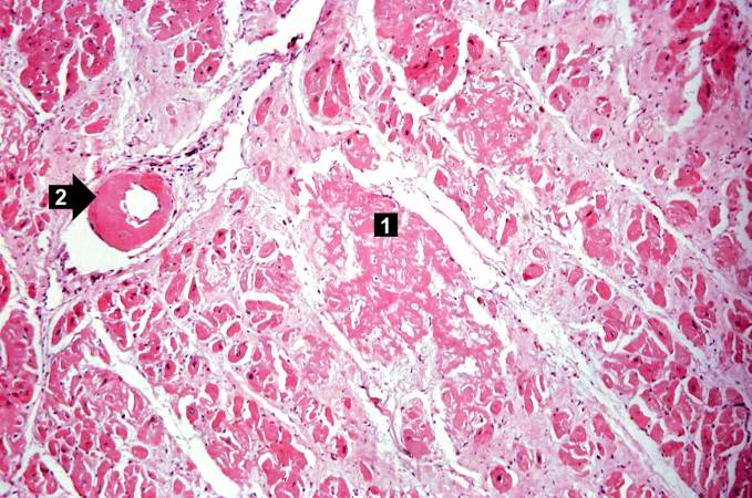This is a higher-power photomicrograph of the heart tissue from this case. Note the amyloid deposition throughout the myocardium (1) as well as deposition in the wall of the blood vessel (2).