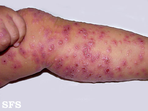 Eczema Herpeticum Wikidoc