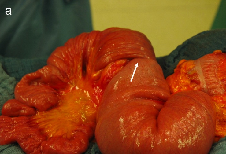 Intussusception of the ileum (large arrow).