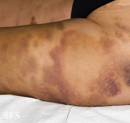 File:Painful bruising syndrome05.jpg