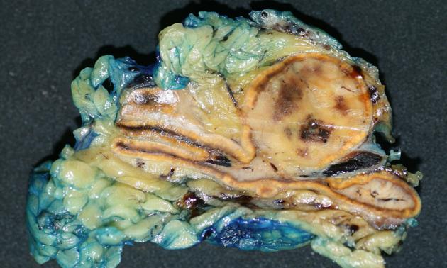 Pheochromocytoma, Image courtesy of Dr Frank Gaillard[16]