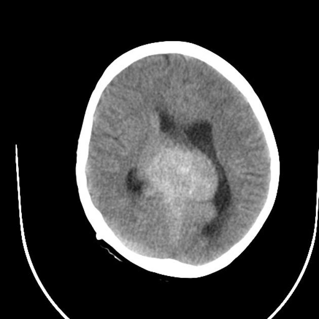 Axial brain CT image demonstrating a large hyperdense lobulated mass in the pineal region with peripheral foci of calcification and associated hydrocephalus. A VP shunt has recently been inserted (note the small amount of pneumocephalus). Hyperdense material is observed coating the frontal horns of the lateral ventricle and filling the floor of the third ventricle.[19]
