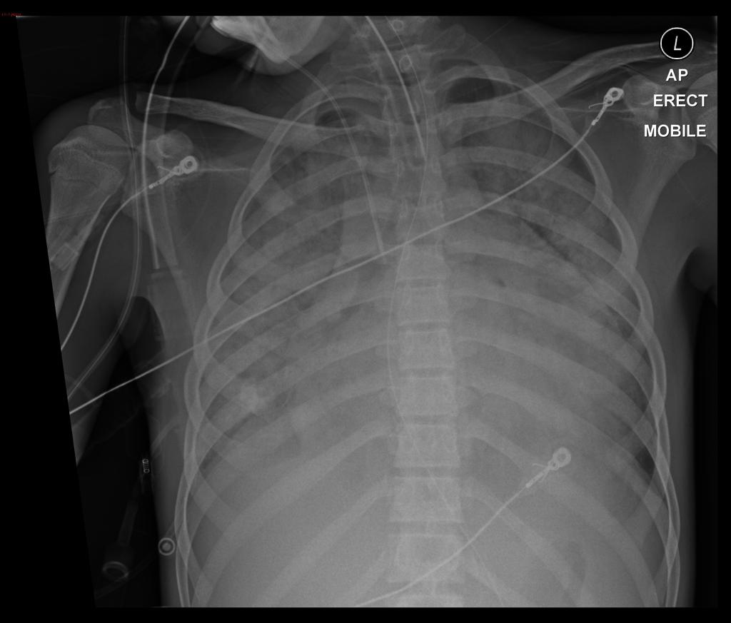 File:Acute Rheumatic Fever X-Ray 2.jpg