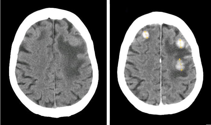 CT scan of head before (left image) and after (right image) injection of iodinated contrast of a 75 year old patient demonstrating three brain metastatic masses from breast cancer with large peripheral edema.[1]