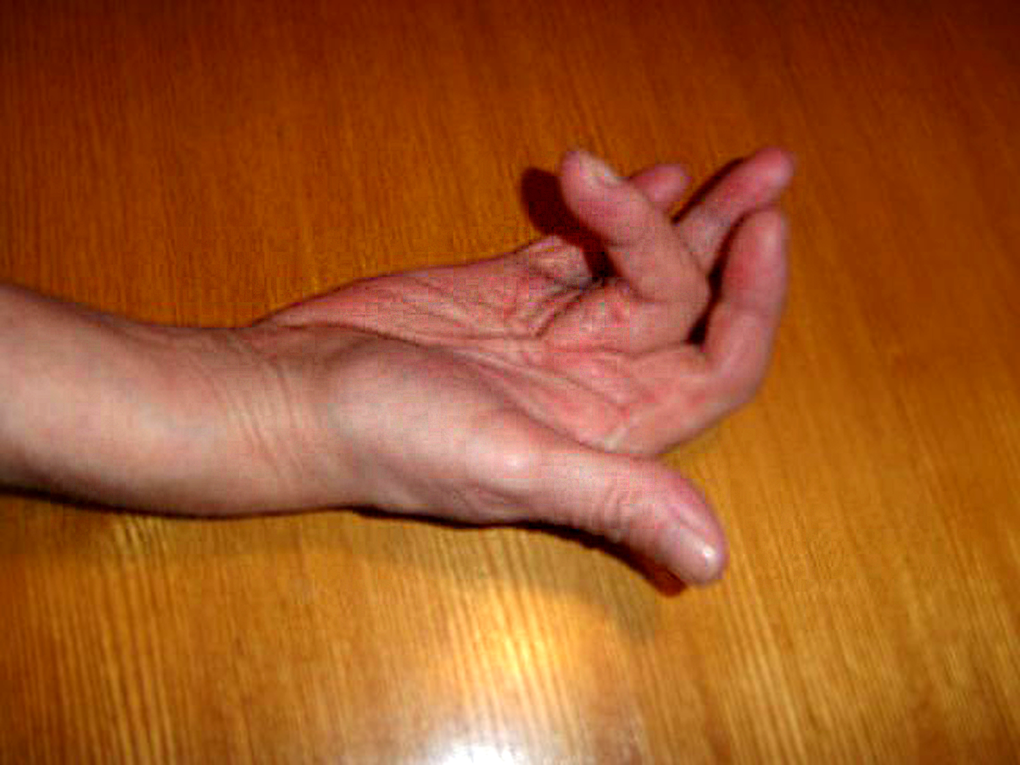 File:Dupuytren's contracture-1.jpg