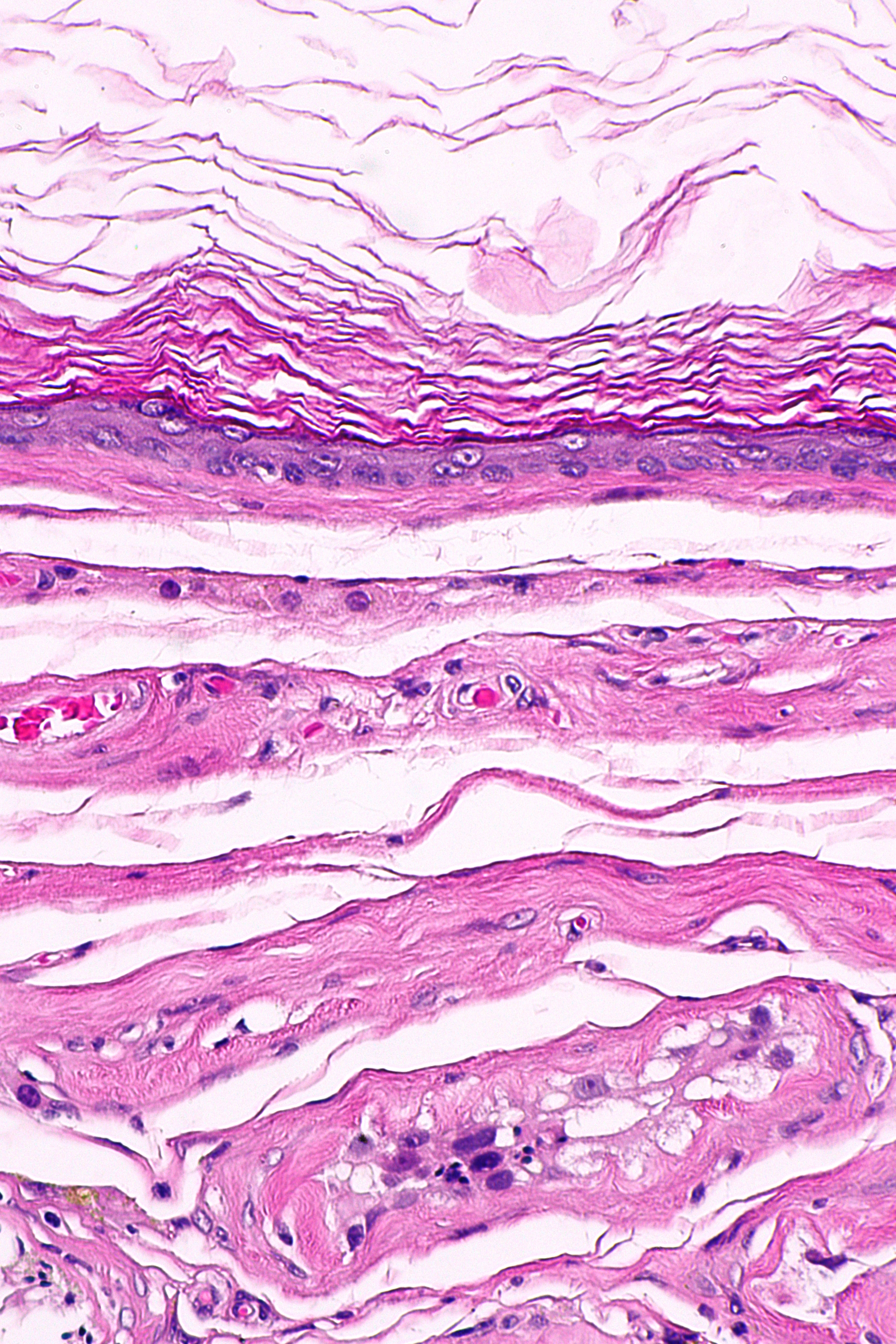 File:Epidermoid cyst of testis -- high mag.jpg