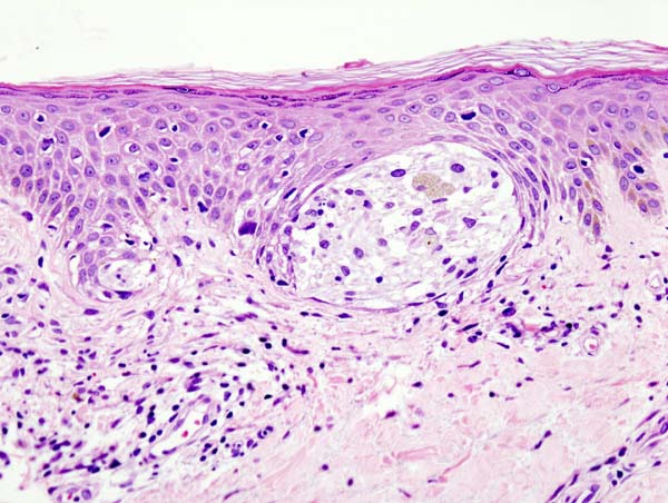 Malignant melanoma in skin biopsy with H and E stain.