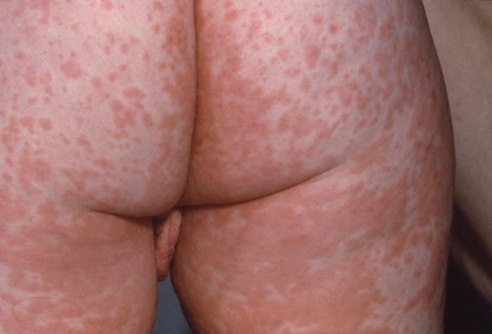 Characteristic red blotchy pattern on his buttocks during 3rd day of the rash.