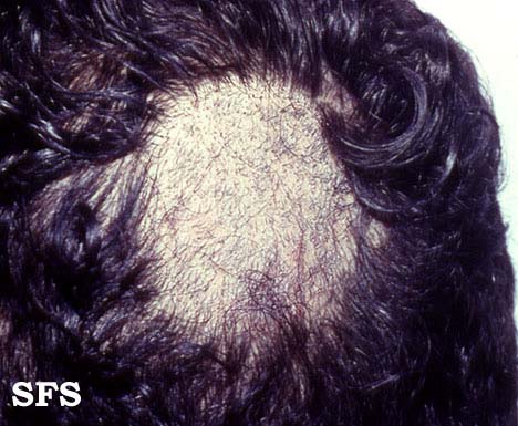 Tinea capitis. Adapted from Dermatology Atlas.[10]