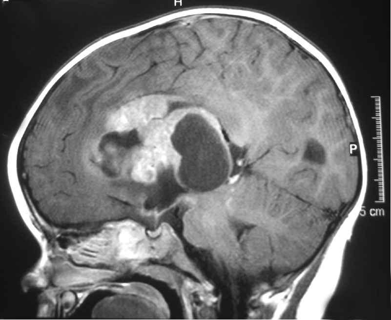 File:ATRT-MRI v2.jpg