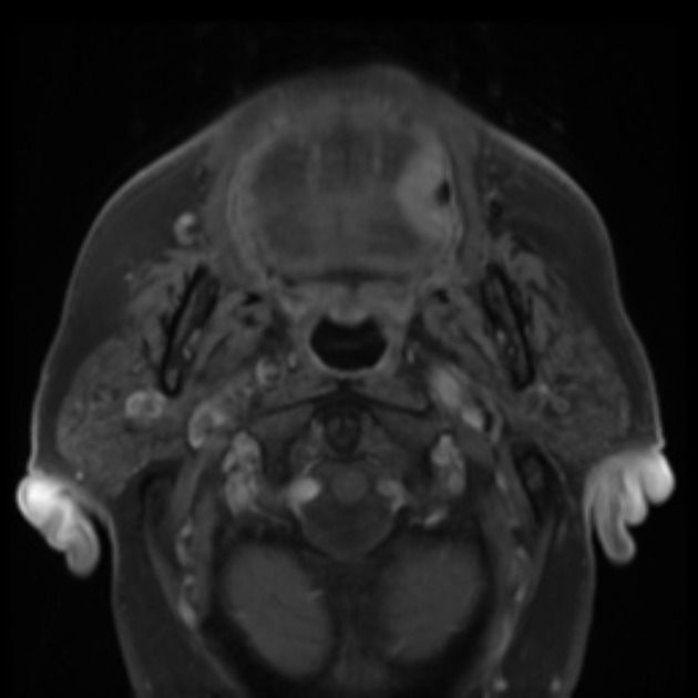 Axial T1 fat saturated MRI of squamous cell carcinoma of tongue [2]
