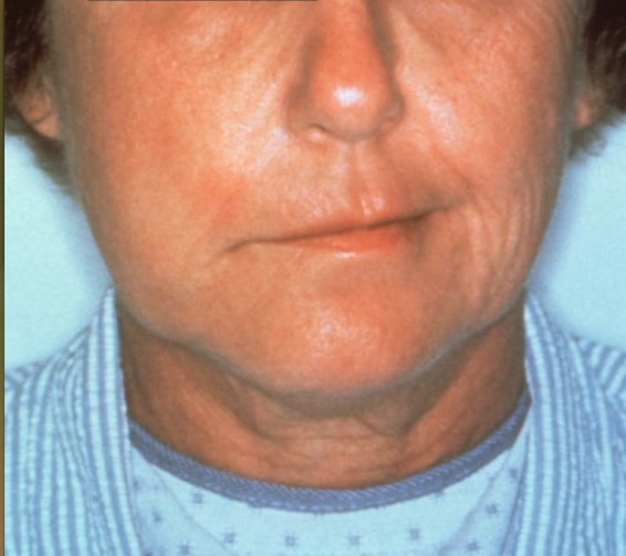 Facial palsy caused by an infection by the bacterial spirochete Borrelia burgdorferi. Patient was subsequently diagnosed with Lyme disease. From Public Health Image Library (PHIL). [3]