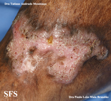 Chromomycosis. Adapted from Dermatology Atlas.[1]