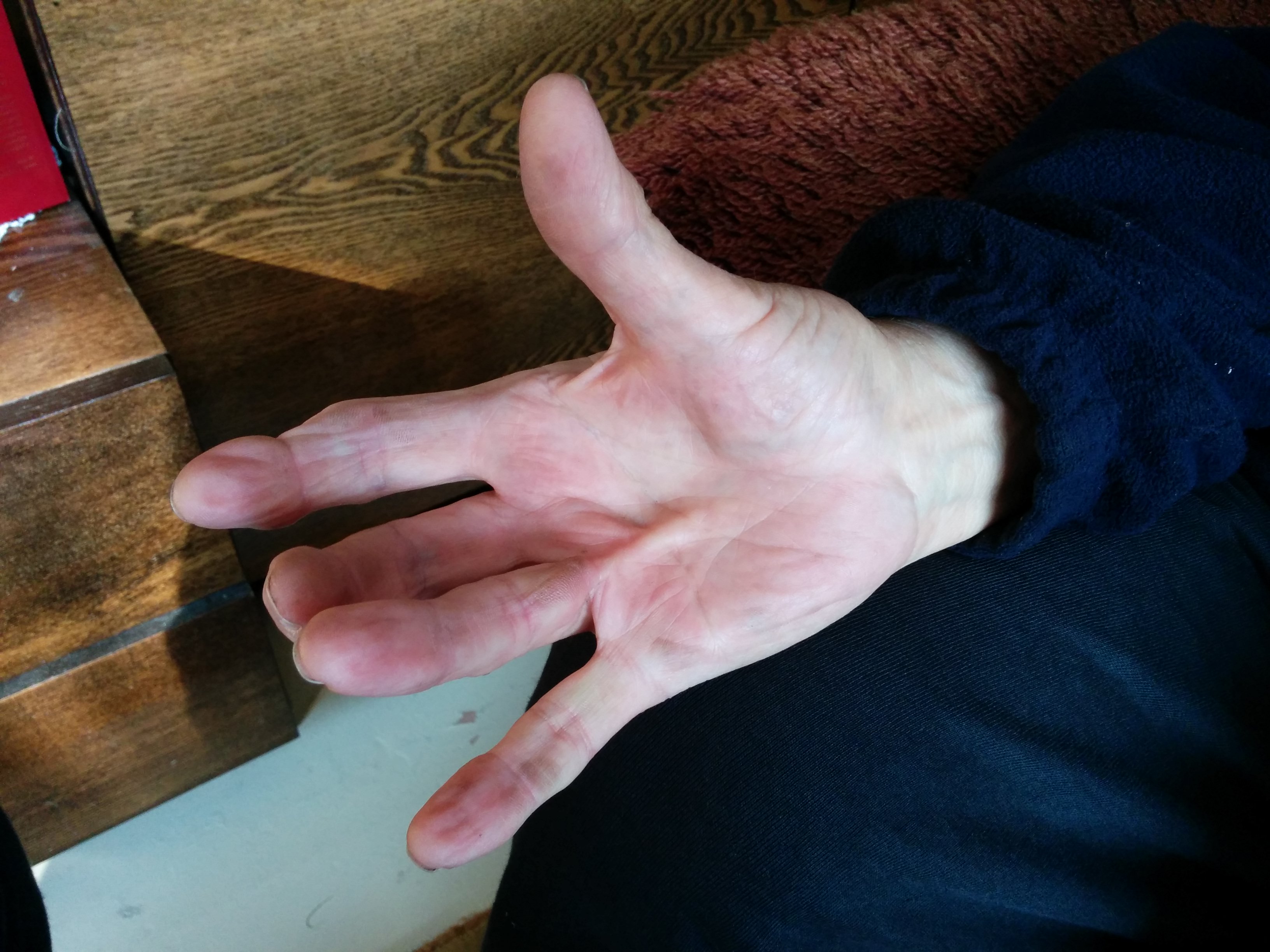 Dupuytren´s Contracture on the ring finger