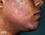 Folliculitis Of Barbae. With permission from Dermatology Atlas.