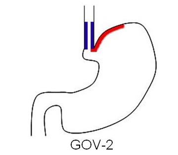 Gastroesophageal varices type 2, via Wikipedia.org