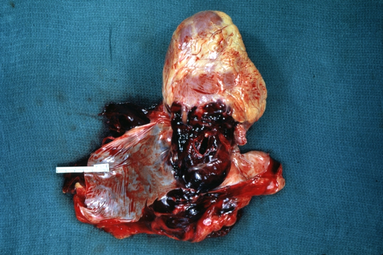 Hemopericardium in dissecting aneurysm: Gross, heart with root of aorta to show hemorrhage into pericardium (very good example)